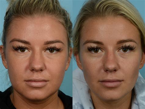 buccal fat removal norge